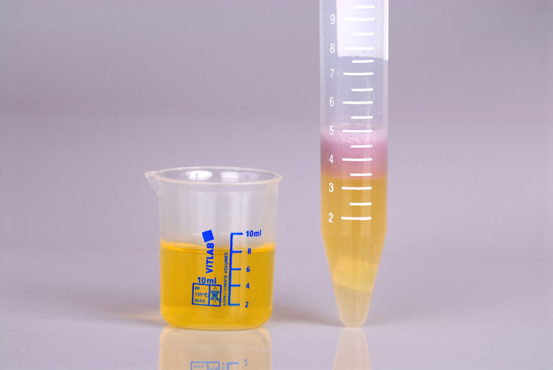 Copper Urine Test - possitive to copper toxicity
